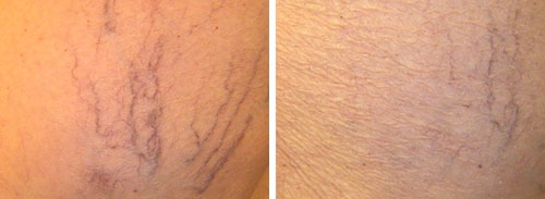Photo avant / après traitement des varicosités au laser